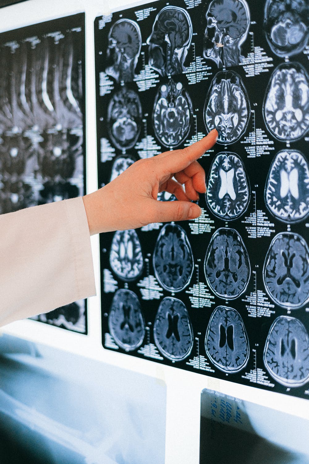 xray images of several brains with doctor hand pointing at them